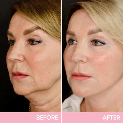 V-Face 👑 Lifting Invisible Adhesive Tape